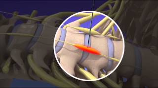 Stellate Ganglion Block [upl. by Ghassan21]