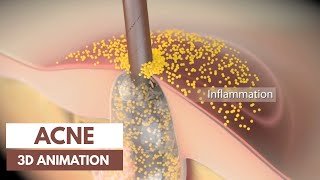 Acne basics  Pathophysiology amp Treatment  3D Animation [upl. by Clary108]