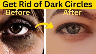 Say Goodbye to Dark Circles Natural Remedies to Get Rid of Under Eyes Dark Circles [upl. by Carlstrom]