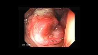 Colonoscopy of Colon Cancer [upl. by Naraa418]