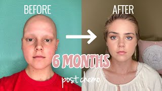 cancer vlog Post chemo HAIR GROWTH journey [upl. by Yllah]