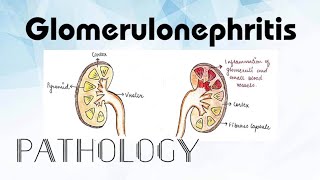 Glomerulonephritis Pathology [upl. by Dranal]