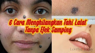 Wajib Dicoba 6 Cara Menghilangkan Tahi Lalat Tanpa Efek Samping [upl. by Egamlat]