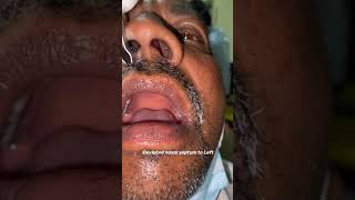 Deviated nasal septum to left seen on anterior rhinoscopy [upl. by Akehsar135]