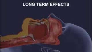 Introduction To Respironics CPAP CFlex Part 1 [upl. by Nanoc]