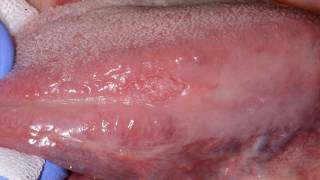 What Are The Early Signs Of Mouth Cancer [upl. by Valerio397]