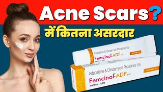 Adapalene Gel On Face  Femcinol ADP  Clindamycin Phosphate Gel  Acne Scars Treatment [upl. by Thor]