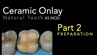 Lithium Disilicate Ceramics Part 2 Ceramic Onlay Preparation [upl. by Scrivings859]