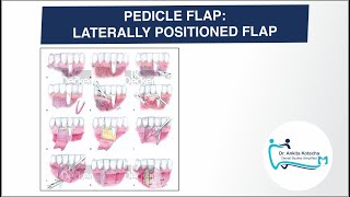 LATERALLY POSITIONED FLAPROTATIONAL PEDICLE FLAPSROOT COVERAGE TECHNIQUETECHNIQUES CLASSIFICATION [upl. by Aened787]