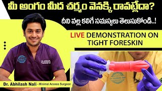 Live Demonstration on Tight Foreskin  Phimosis and Balanitis  Circumcision  Dr Abhilash Nali [upl. by Lehcim]