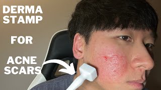 Microneedling before and after Get rid of acne scars using derma stamp at home [upl. by Eiramanel]