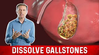 What Causes Gallstones amp How to Treat Them – DrBerg [upl. by Haynor807]