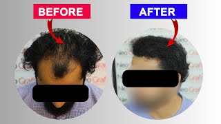 गंजेपन से छुटकारा  Neo Dht Hair Transplant In Chandigarh  hairtransplant neodht [upl. by Zelikow]