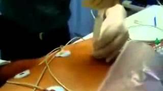 Toracocentesis con aguja en Neumotorax a tensionwmv [upl. by Draneb]