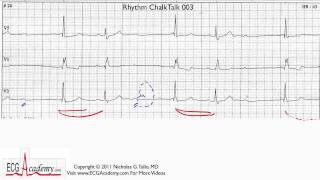 ECG Interpretation Tutorial  ChalkTalk 03  Advanced Level [upl. by Coe64]