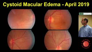 Cystoid Macular Edema [upl. by Archambault]