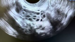 Ultrasound of polycystic ovaries [upl. by Cirderf]