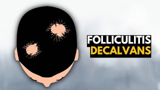 Folliculitis Decalvans What You Need To Know [upl. by Yand643]