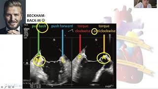 Echo To Guide MitraClip Procedure [upl. by Janette]