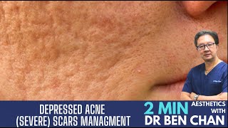 Depressed Acne Scar Management [upl. by Anidualc]