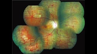 Diabetic retinopathy treatment explained  Ohio State Medical Center [upl. by Schaaff]