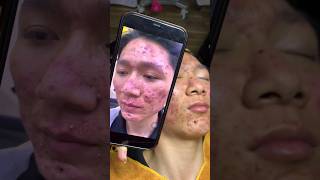 loan nguyen acne treatment amp Dr Lee pimple Popper Blackhead blackheads [upl. by Aicek]