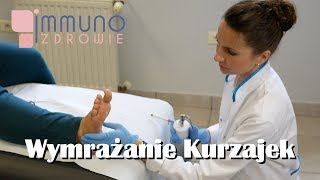 Wymrażanie Kurzajek Ciekłym Azotem Kriochirurgia [upl. by Oicam]