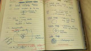 central ossifying fibroma [upl. by Sybyl]