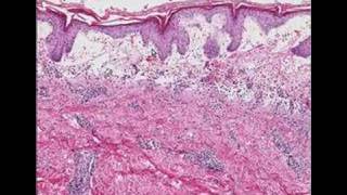 Histopathology SkinErythema multiforme [upl. by Fairweather]