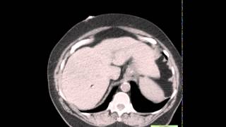 CT Epiploic Appendagitis [upl. by Adniroc923]