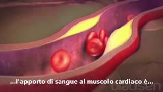 Linfarto del miocardio [upl. by Aldredge]