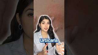 How I Cured My Urticaria Chronic Hives  My Story [upl. by Nadnarb]