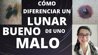 DERMATÓLOGA te explica CÓMO SABER SI un LUNAR es BUENO o MALO [upl. by Tara]