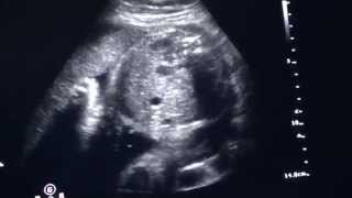 30 WEEKS PREGNANT ULTRASOUND VIDEO [upl. by Temp829]