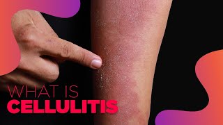 What is Cellulitis  Symptoms and Treatment Options [upl. by Anaeco441]