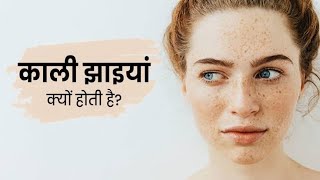 चेहरे की झाई  remove pigmentation  remedy of melasma  elocon cream  Freckles face  Jhaiya [upl. by Anirbys329]