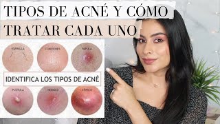 TIPOS DE ACNE Y COMO TRATARLOS [upl. by Ruhnke]