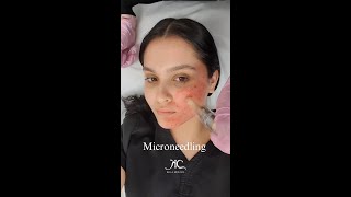 Microneedling [upl. by Cirillo]