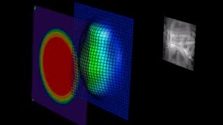 Stanford Hospitals amp Clinics laser vision correction wavefront LASIK [upl. by Hirasuna194]