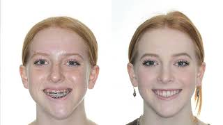 Corrective Jaw Surgery with Drs Relle and Walline  Los Angeles [upl. by Yesnik]