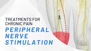 Peripheral Nerve Stimulation  What You Need To Know [upl. by Anerrol618]