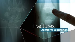 Vers une meilleure réparation des fractures [upl. by Su384]