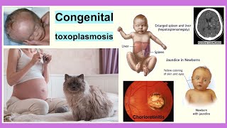 congenital toxoplasmosis [upl. by Dijam]