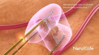 NanoKnife System Ablation Animation [upl. by Eilema]