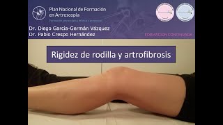 Rigidez de Rodilla y Artrofibrosis Artrolisis Artroscópica Artroscopia de Rodilla [upl. by Yemrej]