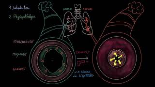 Asthme  Introduction  Physiopathologie  Triggers  Signes et symptomes [upl. by Assiralk244]