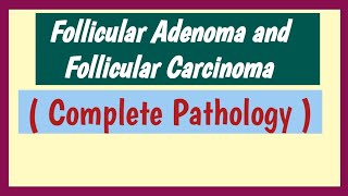 Follicular Adenoma And Follicular Carcinoma  Thyroid Neoplasm [upl. by Eimirej]