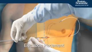 SICD Implant Procedure Animation [upl. by Sarette]