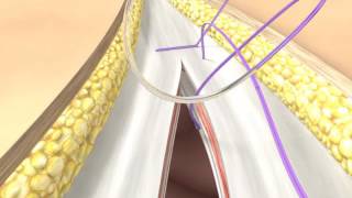 Abdominal Wall Closure BBraun [upl. by Blen]