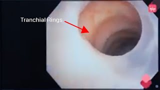 Real Brochoscopy procedure  How its done [upl. by Yvaht]